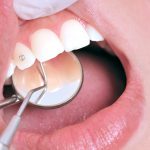 grillz salud oral