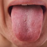 candidiasis oral