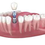 duele implante dental