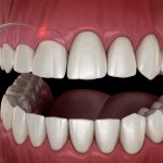 sonrisa gingival