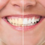 blanqueamiento dental