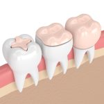 reconstrucción dental